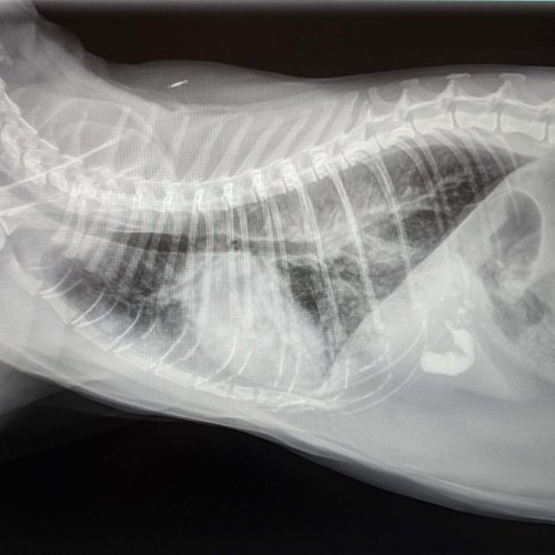 Lung Edema