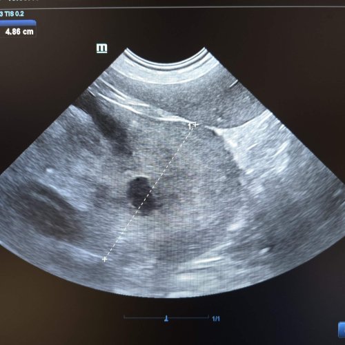Spleen Tumor