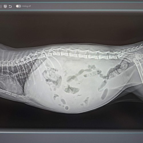 Abdominal Effusion