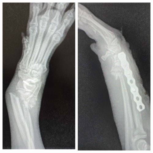 Bone Fracture